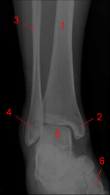 ankle radiograph, AP projection