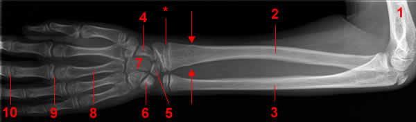 forearm x-ray, ap projection