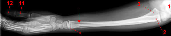 forearm x-ray, lateral projection