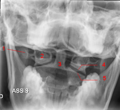 Cervical Spine X-Ray: Image 3