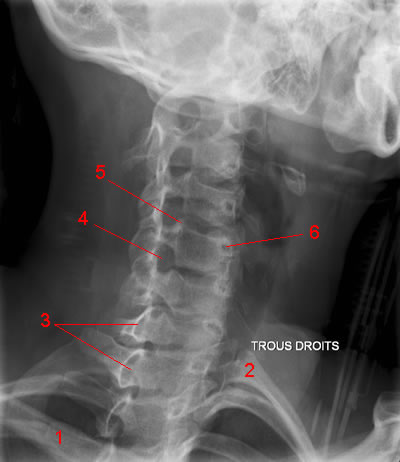 Cervical Spine X-Ray: Image 5