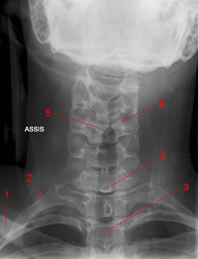 Cervical Spine X-Ray: Image 1