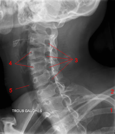Cervical Spine X-Ray: Image 4