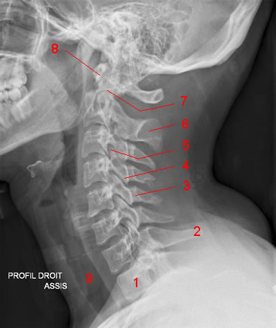 Cervical Spine X-Ray: Image 2
