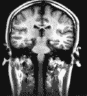 IRM cerveau: coupe coronale