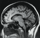 IRM cerveau: coupe sagittale
