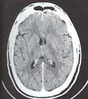 CAT-scan cérébral