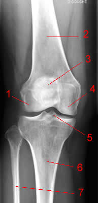 Knee Radiograph - AP