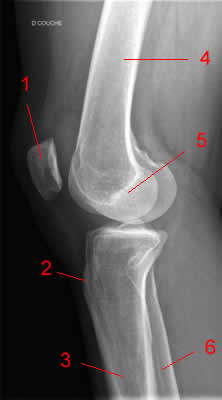 Knee Radiograph - Lateral