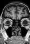 Lobe frontal, IRM, coupe sagittale, Pondération T1. Niveau 1. Image 3. 