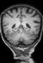 gyrus-temporo-occipital-medial-3_fs