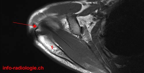 Os acromial. Image 1