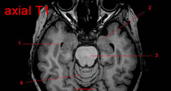 Système limbique, IRM, coupe axiale, Pondération T1. Image 10.