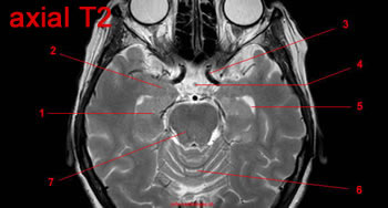 Système limbique, IRM, coupe axiale, Pondération T2. Image 13.
