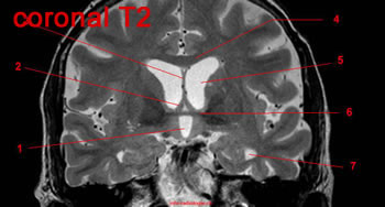 Système limbique, IRM, coupe axiale, Pondération T2. Image 17.