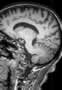 Sillon pariéto-occipital, IRM, coupe sagittale, Pondération T1. Image 1.
