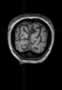 Sillon pariéto-occipital, IRM, coupe coronale, Pondération T1. Image 6.