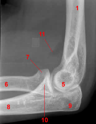 Elbow Radiograph - Lateral projection