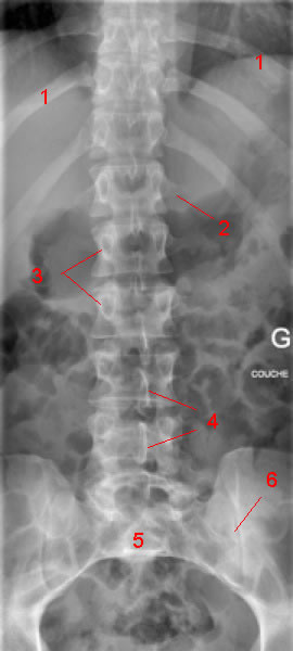 lumbar spine X-ray, AP projection