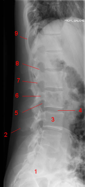 lumbar spine X-ray, Lateral Projection