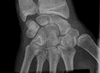 Wrist radiographs. Image 1