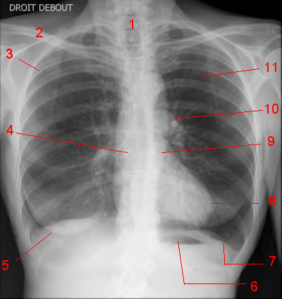 Chest x-ray, ap projection