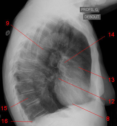 Chest x-ray, lateral projection