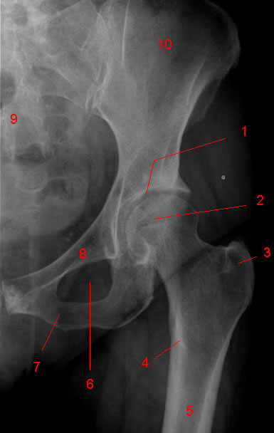 radiographie de la hanche: cliché de face
