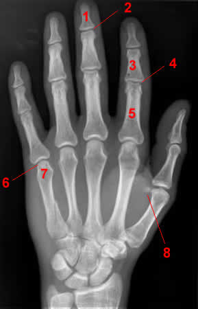 Hand X-ray - AP view
