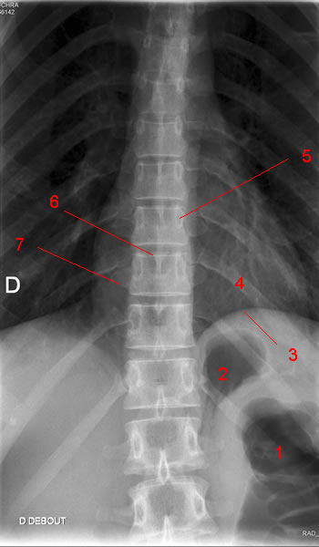 Thoracic spine X-ray. Image 2