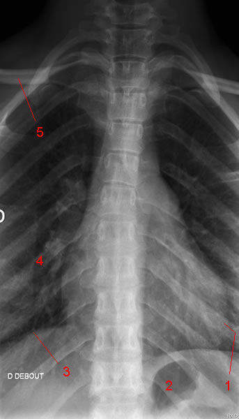 Thoracic spine X-ray. Image 1
