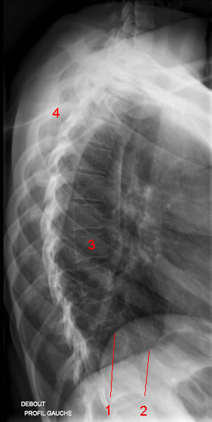 Thoracic spine X-ray. Image 3
