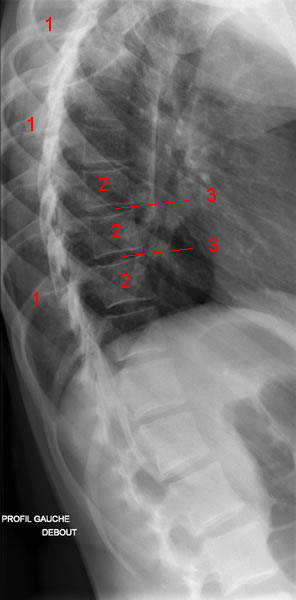 Thoracic spine X-ray. Image 4