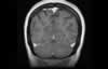 Sinus veineux du cerveau: coupe coronale IRM du cerveau après gadolinium. Image 7