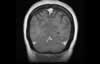 Sinus veineux du cerveau: coupe coronale IRM du cerveau après gadolinium. Image 8