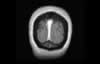 Sinus veineux du cerveau: coupe coronale IRM du cerveau après gadolinium. IMage 11 de 11