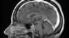 Sinus veineux du cerveau: coupe sagittale IRM du cerveau après gadolinium.