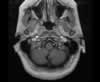 Sinus veineux du cerveau: coupes axiales (IRM du cerveau avec gadolinium). Image 1