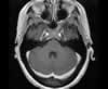 Sinus veineux du cerveau: coupes axiales (IRM du cerveau avec gadolinium). Image 4