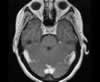 Sinus veineux du cerveau: coupes axiales (IRM du cerveau avec gadolinium). Image 5
