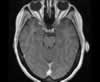 Sinus veineux du cerveau: coupes axiales (IRM du cerveau avec gadolinium). Image 6