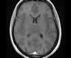 Sinus veineux du cerveau: coupes axiales (IRM du cerveau avec gadolinium). Image 10