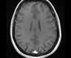 Sinus veineux du cerveau: coupes axiales (IRM du cerveau avec gadolinium). Image 12