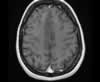 Sinus veineux du cerveau: coupes axiales (IRM du cerveau avec gadolinium). Image 14