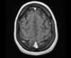 Sinus veineux du cerveau: coupes axiales (IRM du cerveau avec gadolinium). Image 16