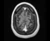 Sinus veineux du cerveau: coupes axiales (IRM du cerveau avec gadolinium). Image 17