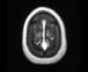 Sinus veineux du cerveau: coupes axiales (IRM du cerveau avec gadolinium). Image 18 de 18