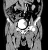 Tumeur de la vessie: Image 2.