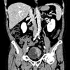 Tumeur de la vessie: Image 4.