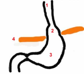 Schéma d'une hernie paraoesophagienne